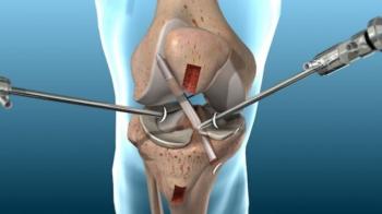 Arthroscopy